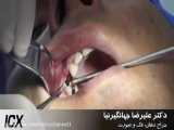 کشیدن و کاشت همزمان دندان چهار بالا ( دکتر جهانگیرنیا )