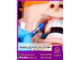 کلینیک دندانپزشکی مهر (mehr_dental_clinic) معجزه لبخند زیباتر با بلیچینگ)