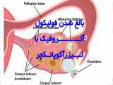 تاثیر لیزر آکوپانکچر بر افزایش ذخیره تخمدان و تشکیل فولیکول