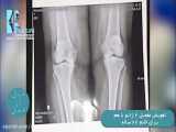 نمونه کار تعویض مفصل هر دو زانو با هم