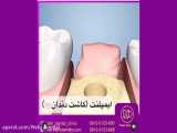 کلینیک دندانپزشکی مهر (mehr_dental_clinic) ایمپلنت (کاشت دندان )