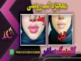 تزریق فیلر لب مدل روسی