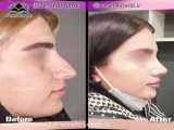جراحی زیبایی بینی کلاسیک