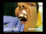 فیلم درمان 8 واحد کامپوزیت ونیر دندان