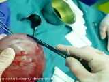جراحی کیست تخمدان بعد از هیسترکتومی