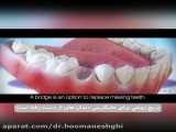 نحوه کارگزاری بریج دندان (پل دندان)| دکتر هومن عشقی