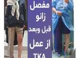 تعویض مفصل زانو قبل و بعداز عمل TKA