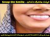 لمینت متحرک دندان -snap on smile