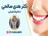 ونیر کامپوزیت دندان های قک بالا و پایین در اصفهان | دکتر هدی صالحی