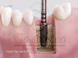 دکتر وحید دهقان: هیلینگ ایمپلنت دندان