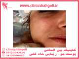 جوانسازی پوست صورت با لیزر آر اف فرکشنال ( RF Fractional )