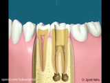 درمان ریشه دندان یا اندو