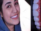 ونیر کامپوزیت دندان های فک بالا با استفاده از ونیر کامپوزیت | دکتر هدی صالحی