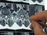 Lumbar disc surgery 3