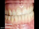سایش های دندانی چیست و انواع سایش دندانی؟