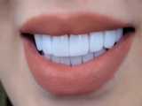 عاقبت ونیر کامپوزیت ارزان وبی کیفیت در دندانپزشکی زیبایی