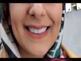 ونیر کامپوزیت و اصلاح دندان های فک بالا با ونیر کامپوزیت در اصفهان