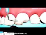 ترمیم شکستگی دندان با کامپوزیت بهترین دندانپزشک ترمیمی تهران