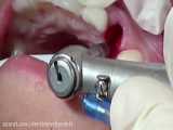 تکنیک کاشت ایمپلنت بدون جراحی توسط دکتر آرش غفوری