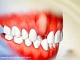 عصب کشی بدون درد جراحی دندان عقل فیلم جراحی دندان عقا نهفته