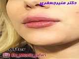 تزریق ژل لب ( فیلر لب )