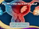 فیبرم رحمی_فیبرم ساب سروزال