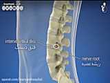 حذف لیزری هرنی دیسک کمر دکتر سید هادی عقیلی