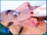 جراحی زیبایی بینی  زنانه