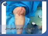 فیلم جراحی انحراف زانو