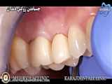 بهترین روکش دندان کدام است؟ tooth crown