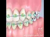 ارتودنسی اقساطی در کلینیک دندانپزشکی لیا