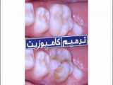 ترمیم کامپوزیت دندان لمینیت دندان انواع ونیر کامپوزیت کلینیک دندانپزشکی
