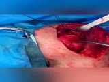 درد شانه پس از جراحی شانه نشانه‌ی چیست؟