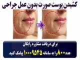 سگی با پنجه های سر و ته بعد از عمل جراحی موفق به راه رفتن شد