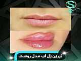 تزریق ژل لب روسی چیست؟