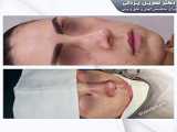 قبل و‌بعد از جراحی زیبایی بینی