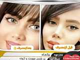 کرم بوتاکس چاقی صورت؛عطاری سلامت09334911527