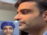 ویدیو جراحی بینی در اتاق عمل | دکتر سعید شیرنگی