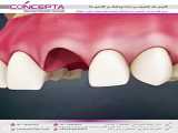 کلینیک دندانپزشکی مهر (mehr_dental_clinic) ایمپلنت دندان