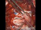 نورومانیتورینگ عمل جراحی Occipitocervical Posterior Spinal Fixation