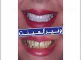 کلینیک دندانپزشکی مهر (mehr_dental_clinic) لمینت سرامیکی