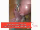 لاپاراسکوپی قسمت دوم