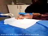 ویدیو نتیجه عمل بینی گوشتی توسط دکتر سعید شیرنگی