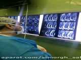 نورومانیتورینگ عمل جراحی Spinal Cord Tumors تومور نخاع