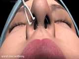 نحوه جراحی رینوپلاستی (جراحی بینی) در مطب دکتر شیرنگی