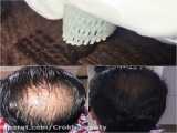 افزایش تراکم یا پرپشت شدن موی سر با روش های مدرن و خانگی