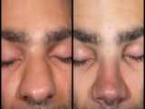 قبل و پنج سال  پس از جراحی بینی  توسط دکتر فیروزه ضیاء متخصص گوش و حلق و بینی