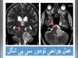 عمل جراحی تومور مخچه