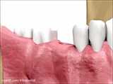 طول درمان ایمپلنت دندان چقدر است؟