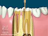 عصب کشی دندان در محدوده میدان فاطمی | کلینیک دندانپزشکی ماهان